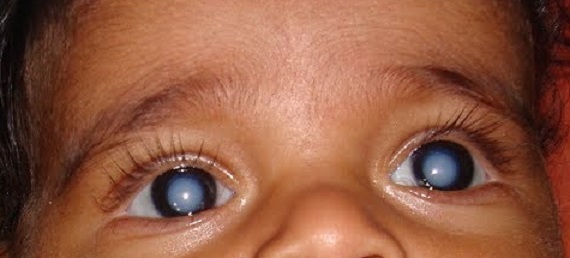 Bilateral cataract